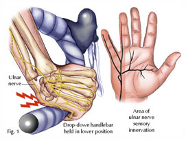 Ulnar nerve entrapment, also known as cubital tunnel syndrome, can cause  several symptoms related to the compression of the ulnar nerve a